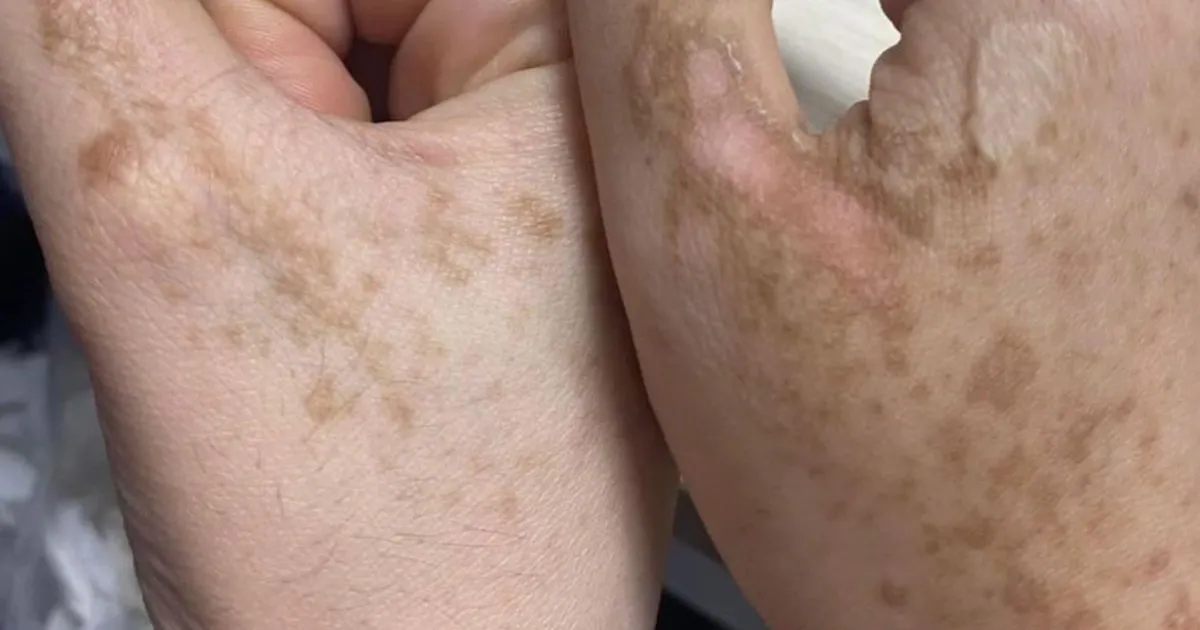 Tác hại của tia UV gây lão hóa và tổn thương da.